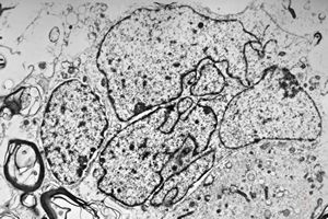 F,15y. | fibrillary astrocytoma